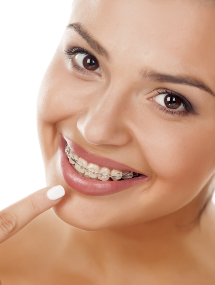 Benefits of Clear Braces