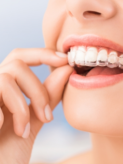 The Benefits of Invisalign